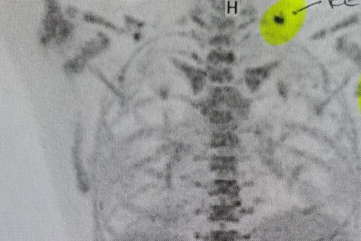 3. Zyklus und mal wieder ein Rückschlag