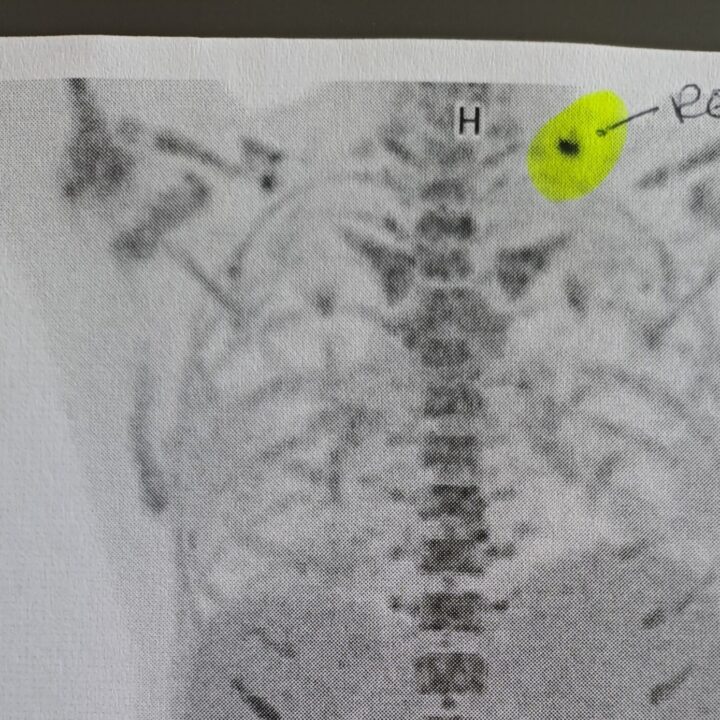 3. Zyklus und mal wieder ein Rückschlag